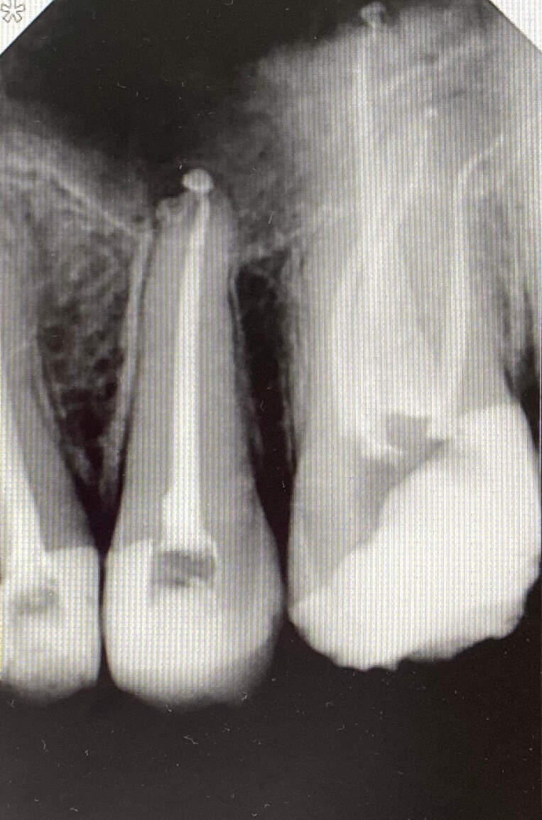 Endodontické ošetrenie Košice v Zubnej Ambulancii Kapadent